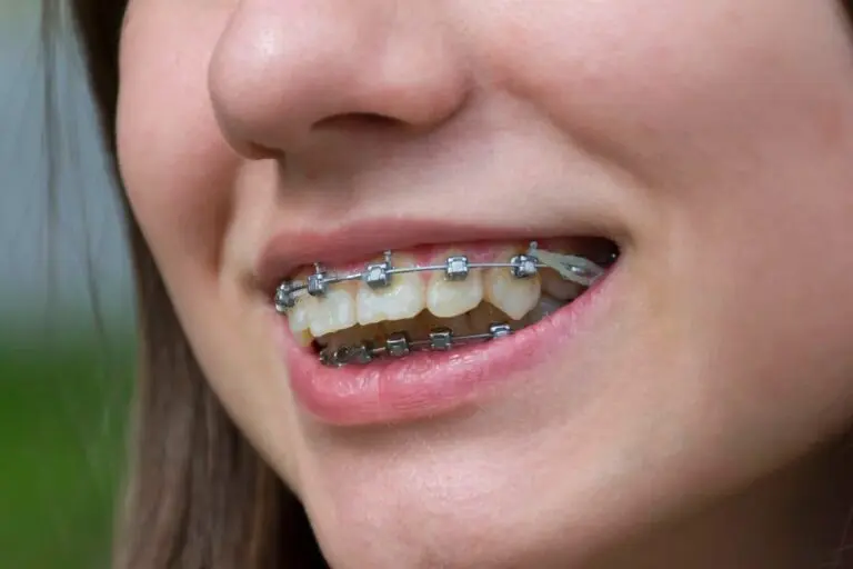 A close-up shows metal braces with elastic bands on a person's slightly smiling mouth at Farr Orthodontics Georgetown' braces for overbite in Georgetown, TX.
