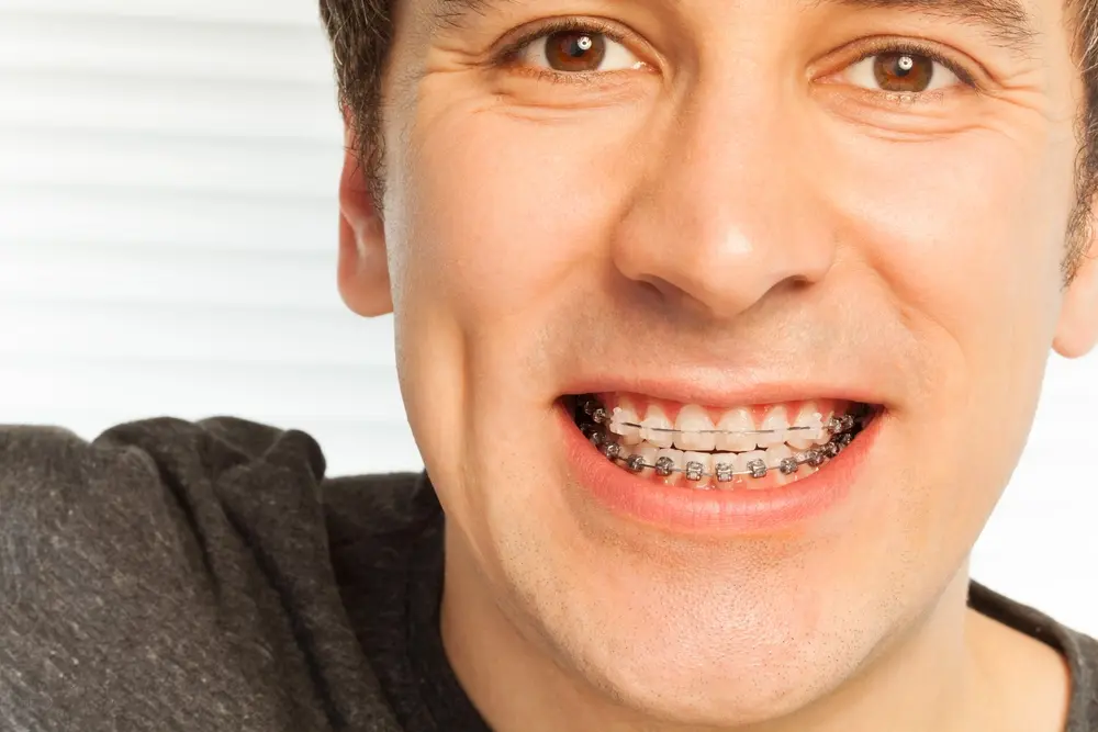 happy young man with metal braces - Overbite vs Underbite in Georgetown, TX. 