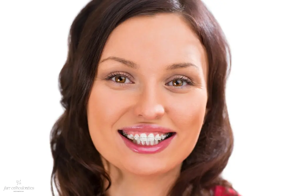 woman wearing orthodontic ceramic clear braces - Overbite vs Underbite in Georgetown, TX. 